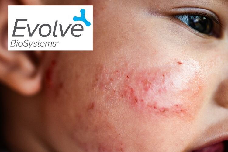 Evivo study on atopic dermatitis reduction