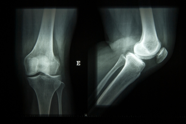 bone health joints x-ray iStock.com raalves